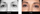 downturned eyes before and after