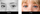 wide set eyes before and after